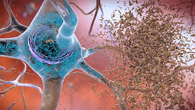 Neurofibrillary tangles and amyloid plaques.