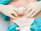 Two hands wearing sterile gloves adjusting a colostomy bag on a patient lying on a bed