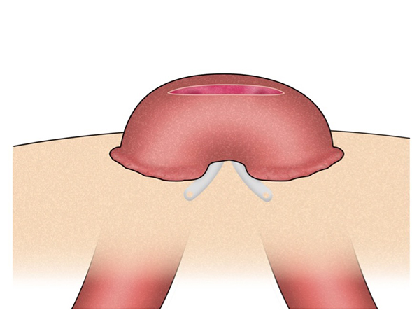 Loop stoma