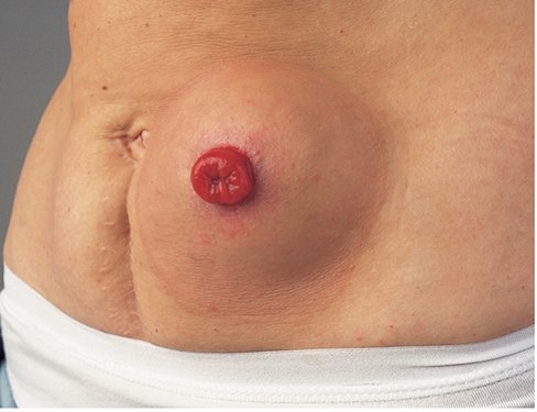 Colostomy stoma on abdomen