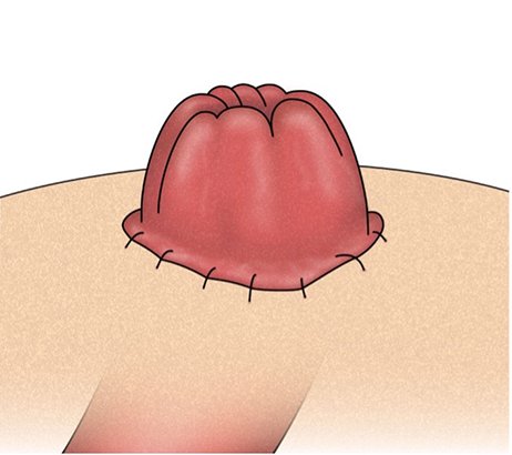 End stoma