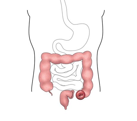 End or sigmoid colostomy
