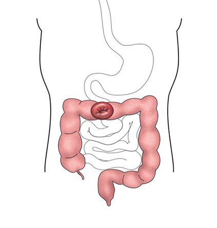 Transverse colostomy