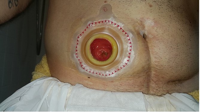 Photo of an ileostomy patient wearing a two-piece ostomy wafer with the ostomy bag removed