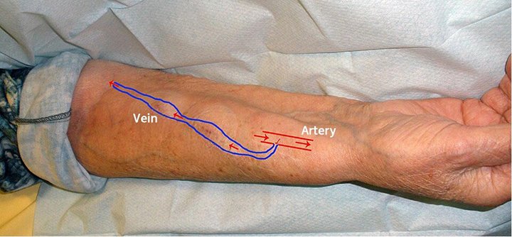 Schema of an arteriovenous fistula used for hemodialysis