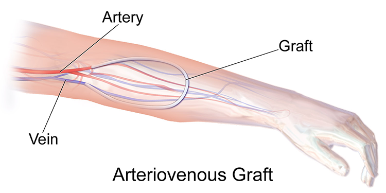Arteriovenus graft