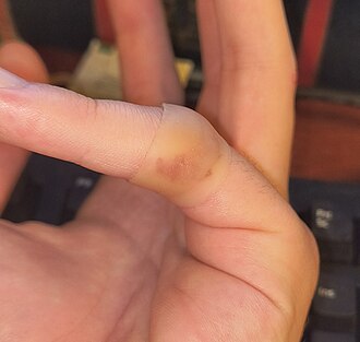 Hydrocolloid dressing applied to a finger