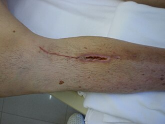 Partially healed wound with dehiscence