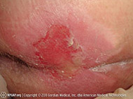 Illustration and photo showing a stage 2 pressure injury