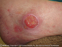 Illustration and photo showing a stage 3 pressure injury