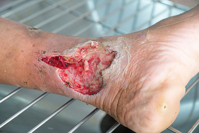 Picture of an infected open wound.