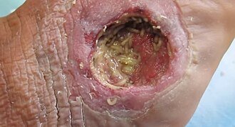 Maggot debridement therapy on a diabetic foot ulcer