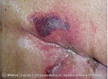 Illustration and photo of deep tissue pressure injury