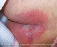 Illustration and photo showing a stage 1 pressure injury