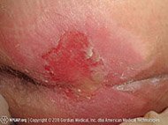 Illustration and photo showing a stage 2 pressure injury