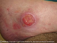 Illustration and photo showing a stage 3 pressure injury