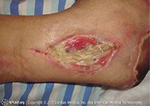 Illustration and photo showing a stage 4 pressure injury