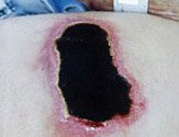Illustration and photo of unstageable pressure injury