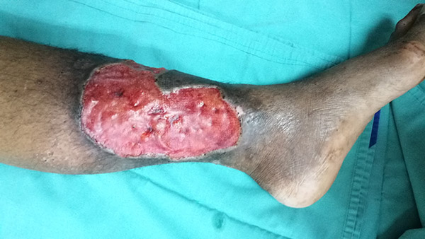 Varicose ulcer with granulation tissue.