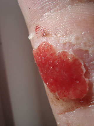 Photograph showing hypergranulation tissue]