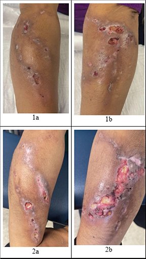 Xylazine-induced wounds