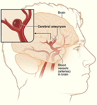 Cerebral aneurysm resulting in hemorrhagic stroke