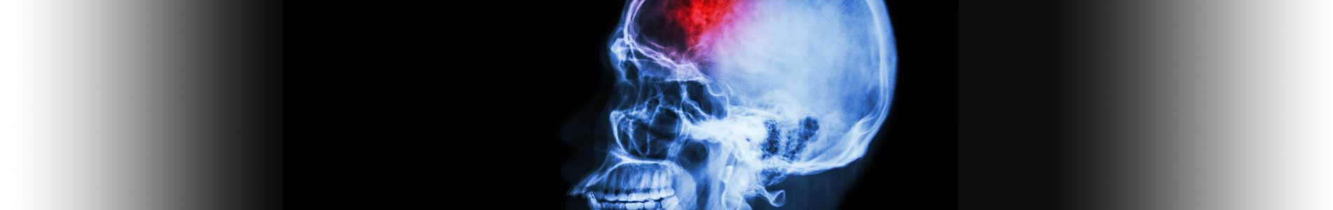 X-ray image of skull from the side in blue with red blood clot area for stroke