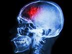 X-ray image of skull from the side in blue with red blood clot area for stroke