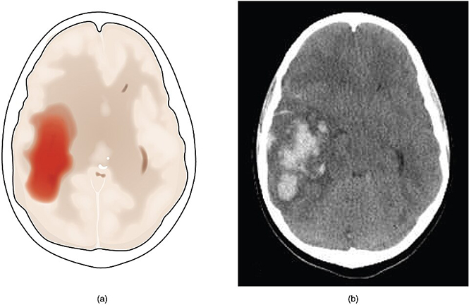 Image of CT scan showing a hemorrhagic stroke