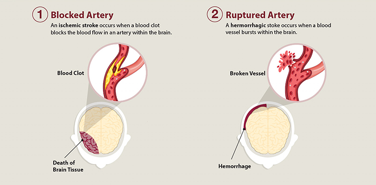 Illustration showing the two types of stroke.