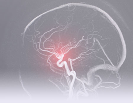 X-ray of a head showing blood vessels representing neurology and stroke nursing CEUs